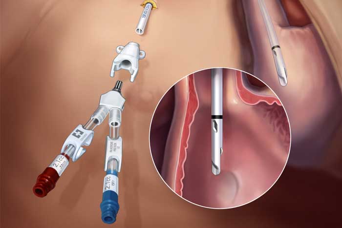 غيار قسطرة غسيل كلوي بالرياض في المنزل